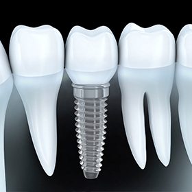 Dental Implants