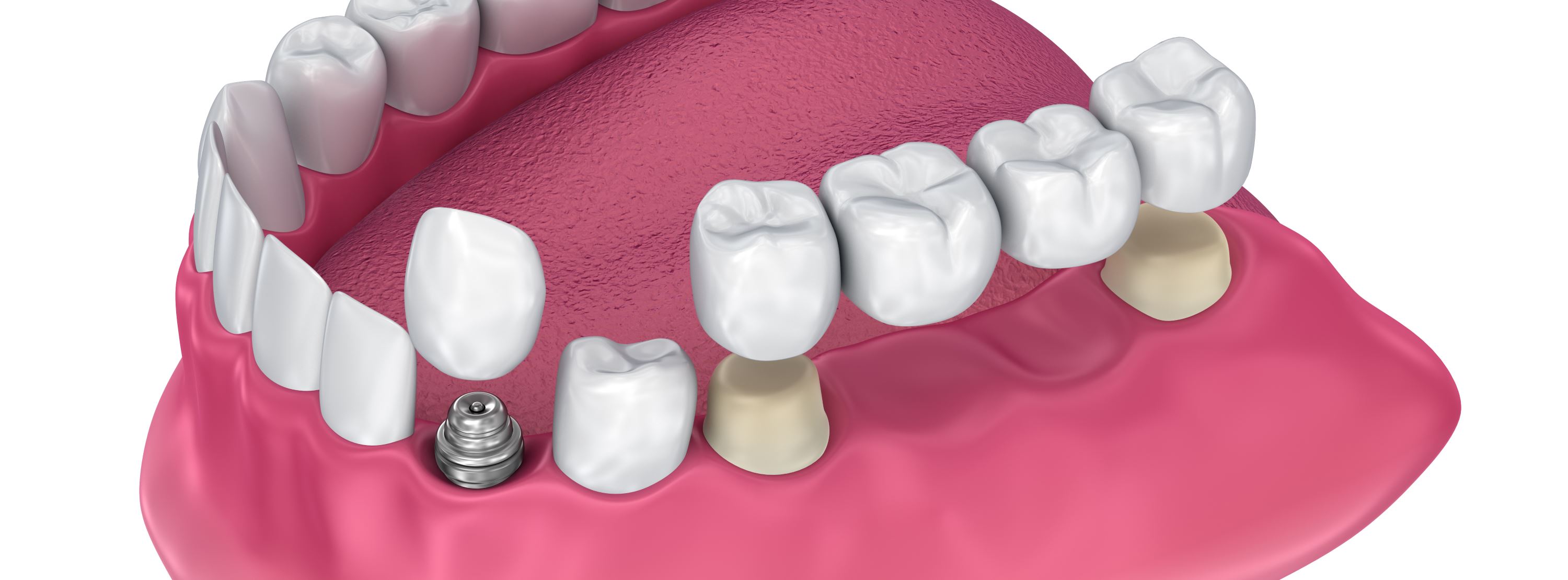 Implant Crowns and Bridges in Midlothian, VA | Neighbors and Herod Family Dentistry Implant Crowns and Bridges in Midlothian, VA | Neighbors and Herod Family Dentistry